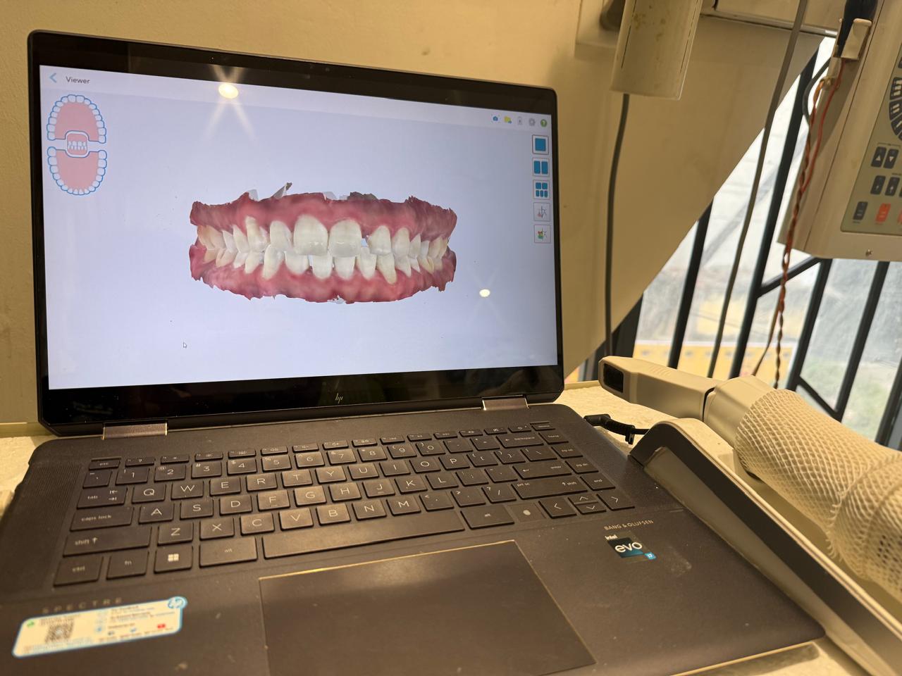 Intra Oral Camera at Darshan Dental Kanyakumari